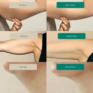 Lymphdrainage